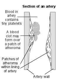 Cross-section diagram of an artery with patches of atheroma