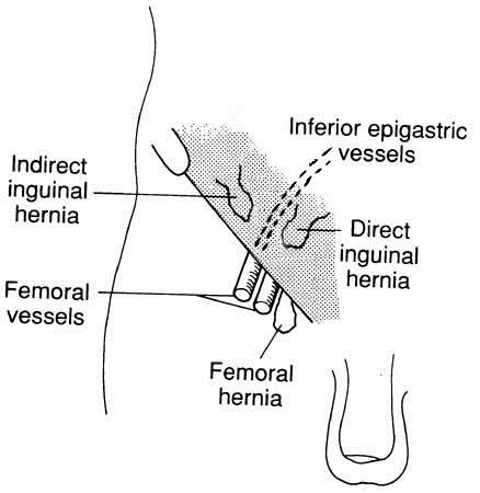 INGUINAL HERNIA