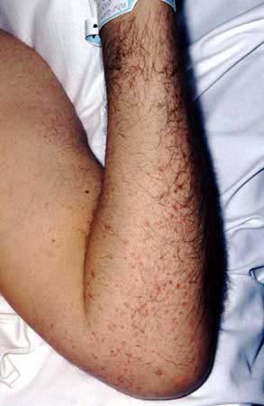 PETECHIAL RASH