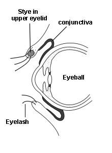 Cross-section diagram of an eye with a stye in the upper eyelid