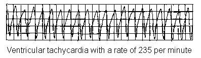 VENTRICULAR TACHYCARDIA