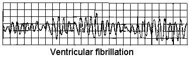 VENTRICULAR FIBRILLATION