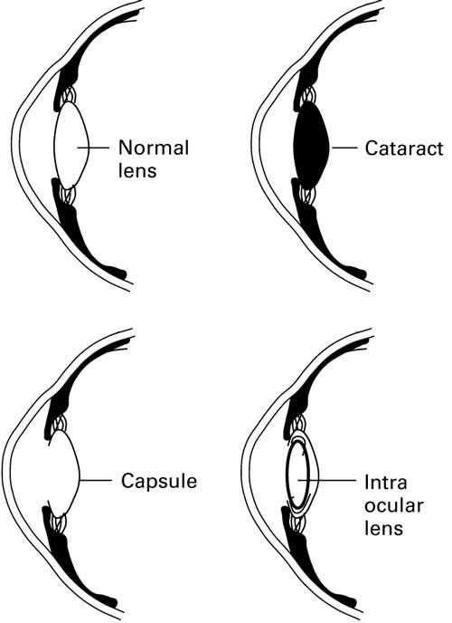 CATARACT