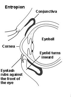 Entropion, also known as eyelid rolls