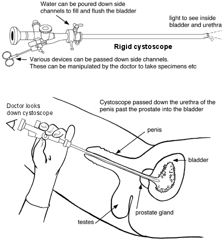 Diagram of a rigid cystoscope and how a cystoscopy is performed