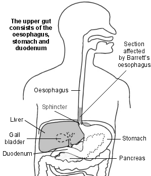 Barrett's Oesophagus