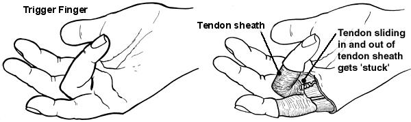 Diagram of the hand showing trigger finger