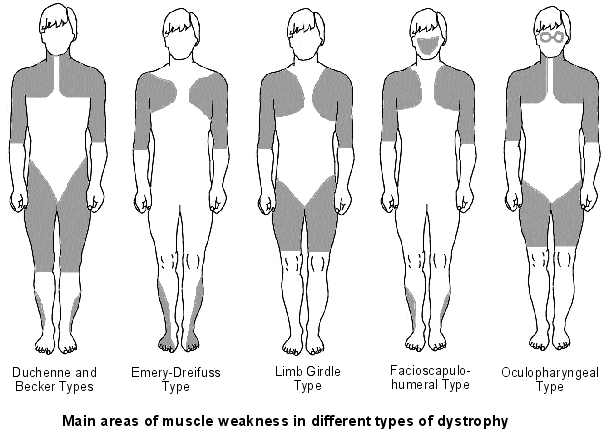 muscle weakness in types of dystrophy