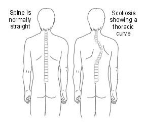 scoliosis