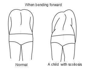 scoliosis diagnosis