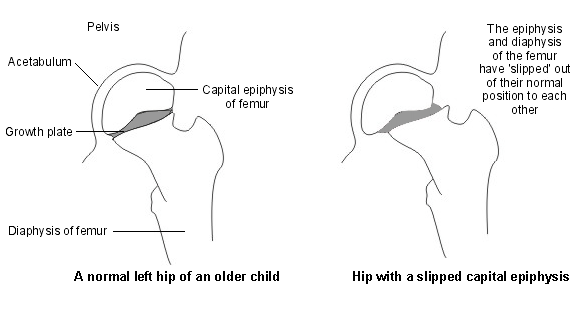 hip with slipped capital epiphysis