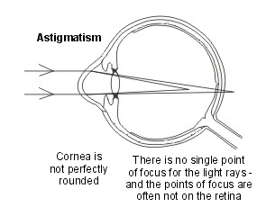 astigmatism