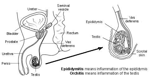 Testis with explanation of epididymitis and orchitis