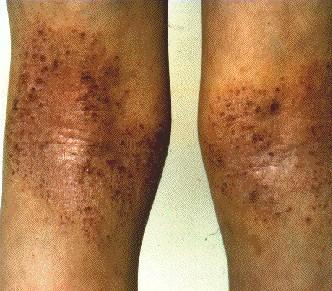 ATOPIC ECZEMA -ON LEGS
  
ATOPIC ECZEMA -ON LEGS