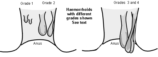 Haemorrhoids (piles)