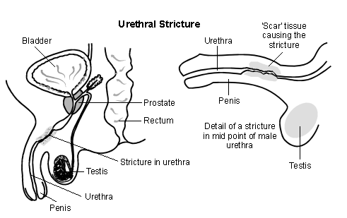 Urethral stricture