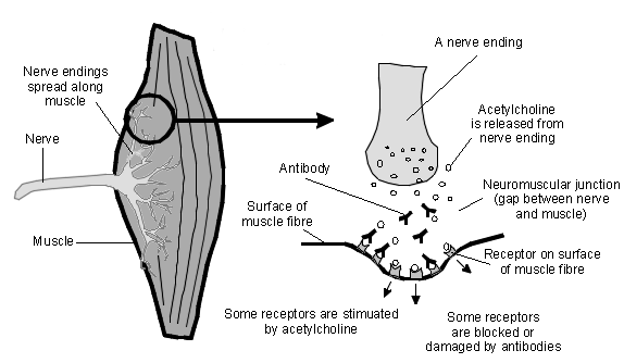 Myasthenia gravis