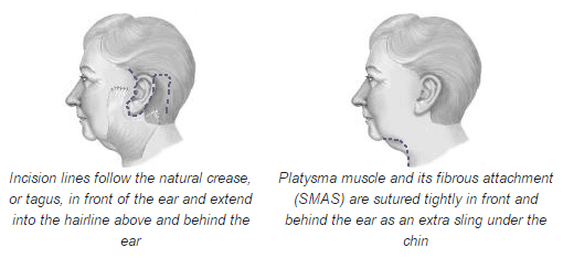 Facelift