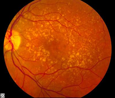 Fundus photo showing dry ARMD