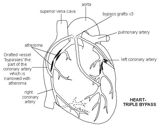 Triple heart bypass