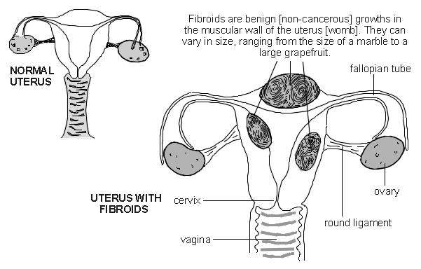 Uterus with fibroids