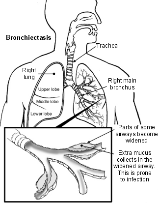 Lungs and airways with bronchiectasis