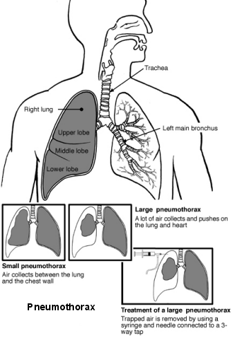 Lungs and airways with pneumothorax