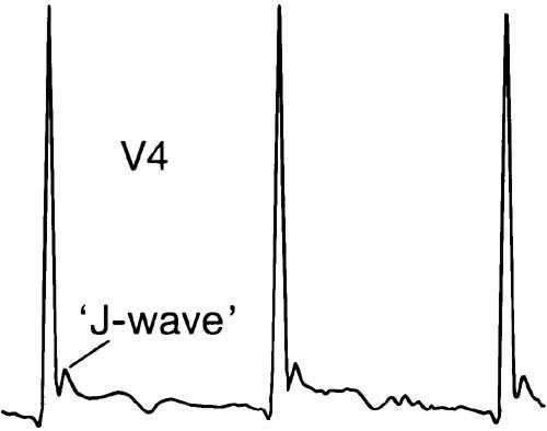 HYPOTHERMIA ECG