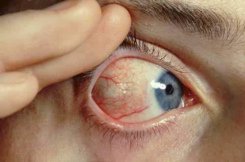 Episcleritis